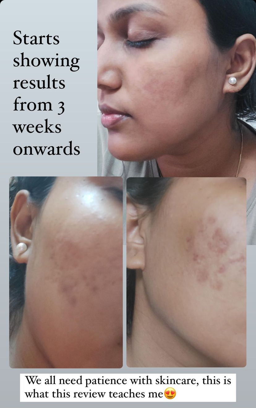 Anti Acne Monsoon Kit