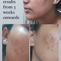Anti Acne Monsoon Kit