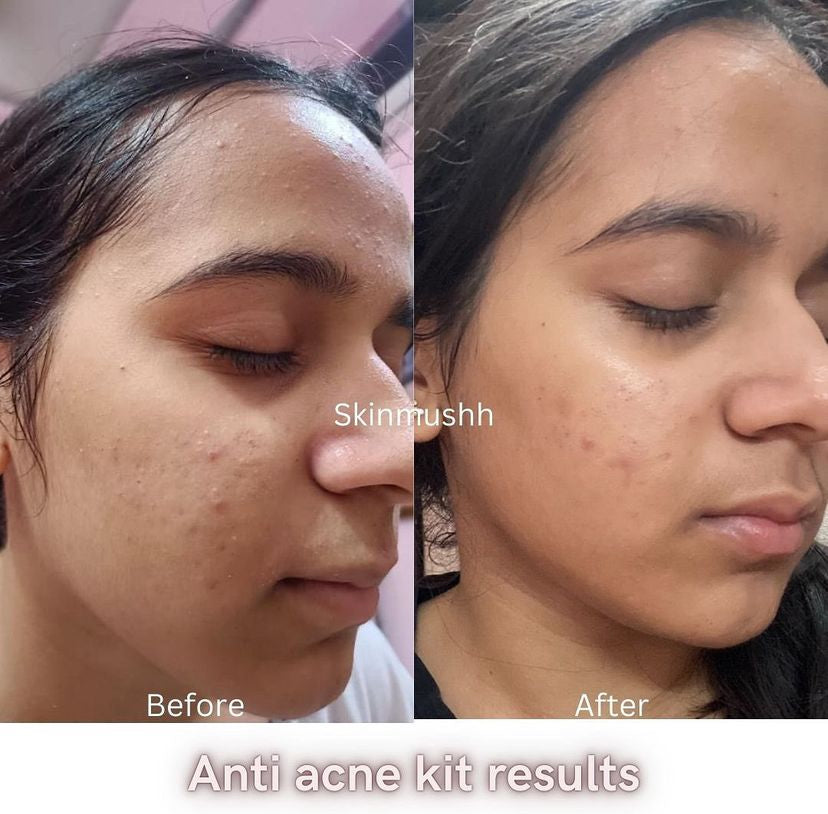 Anti Acne Monsoon Kit