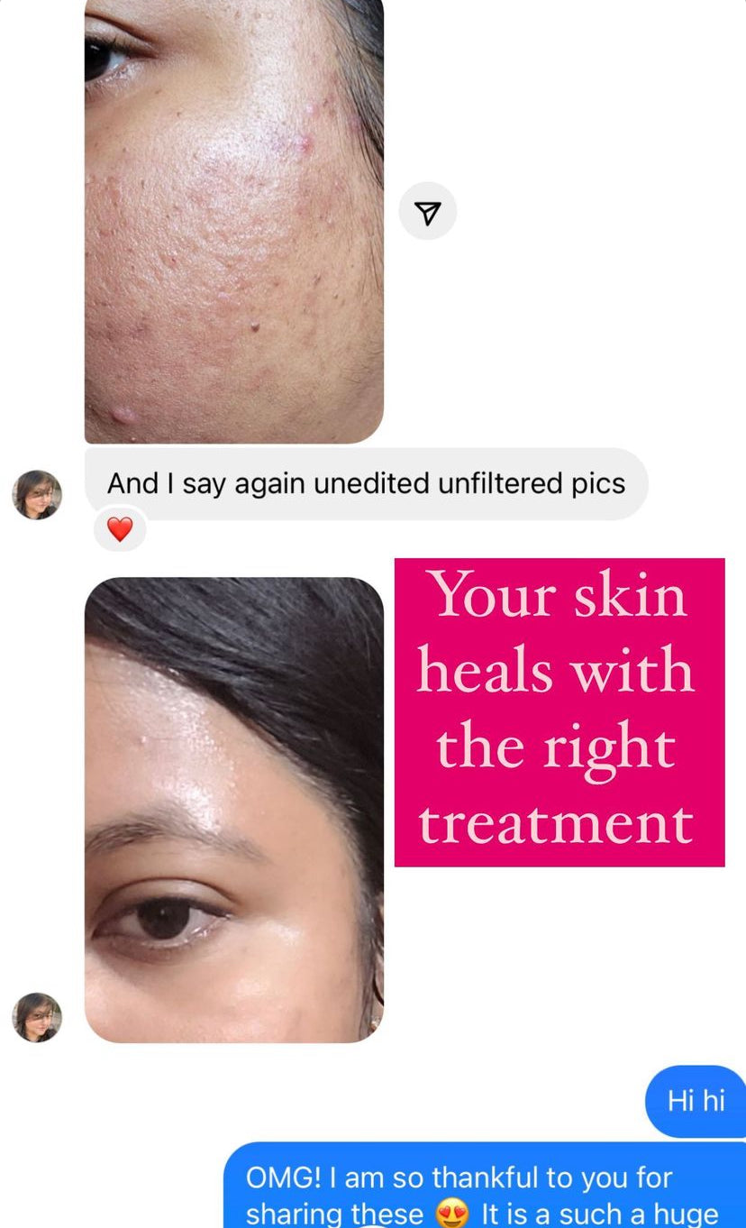 Anti Acne Monsoon Kit