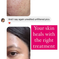 Anti Acne Monsoon Kit